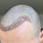 Innovations-greffe-de--cheveux-Choi