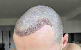 Innovations-greffe-de--cheveux-Choi