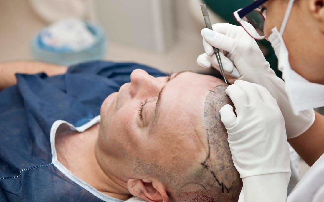 Implantation des greffons au stylo lors d'une greffe de cheveux
