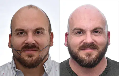 Prix-transplantation-de-barbe-Paris 