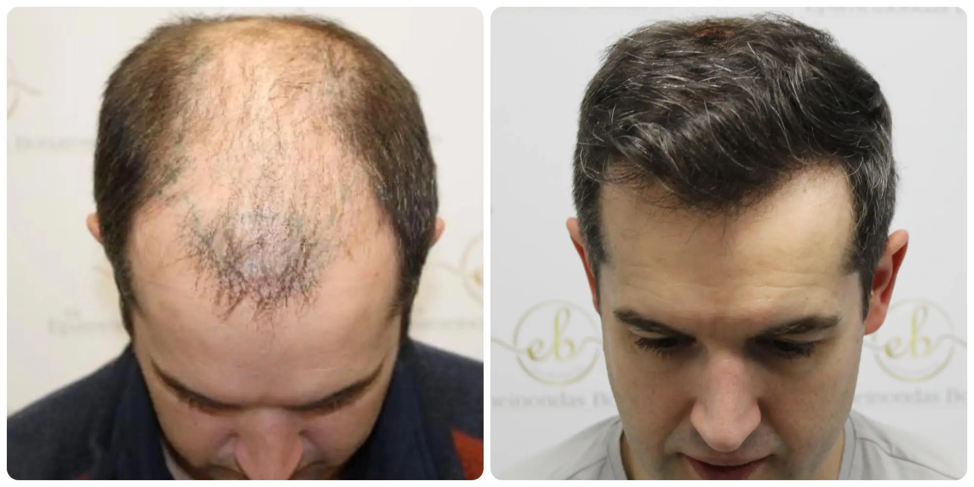 Facteurs qui font varier le prix d'une greffe de cheveux à Lyon