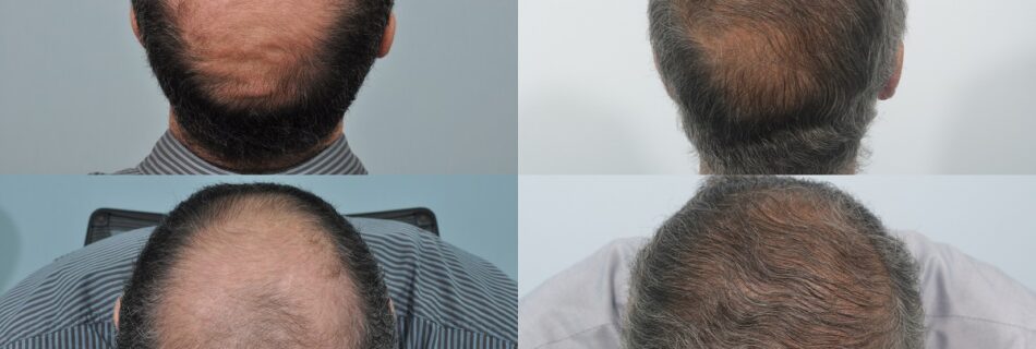 Prix-greffe-capillaire-Paris