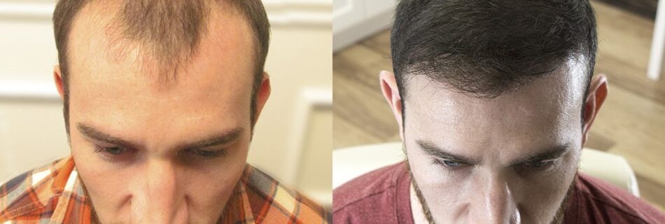 Prix-greffe-capillaire-Turquie