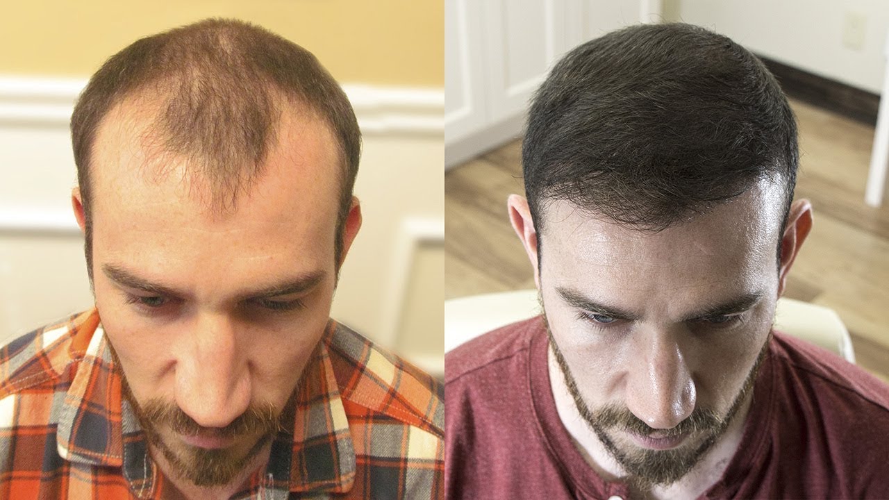Combien coûte une greffe de cheveux en Turquie ?