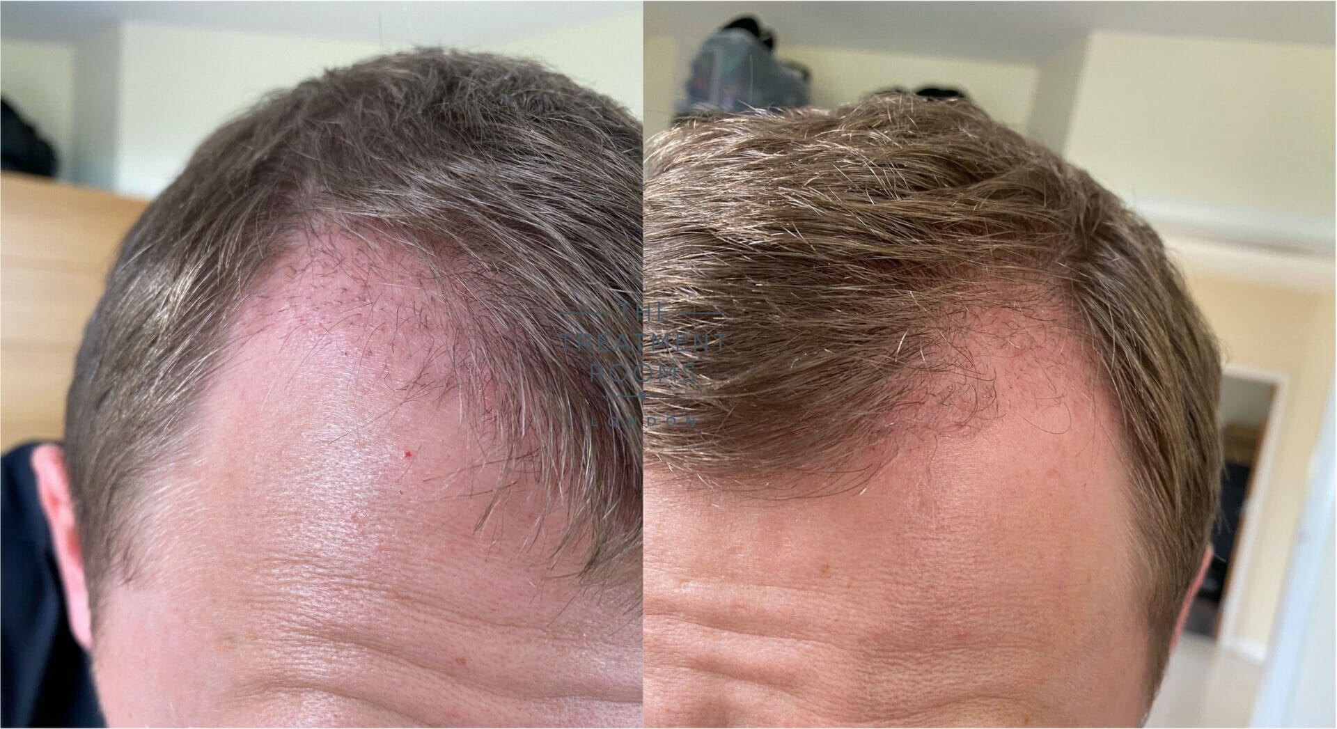 Illustration du remboursement d'une greffe de cheveux par l'Assurance Maladie