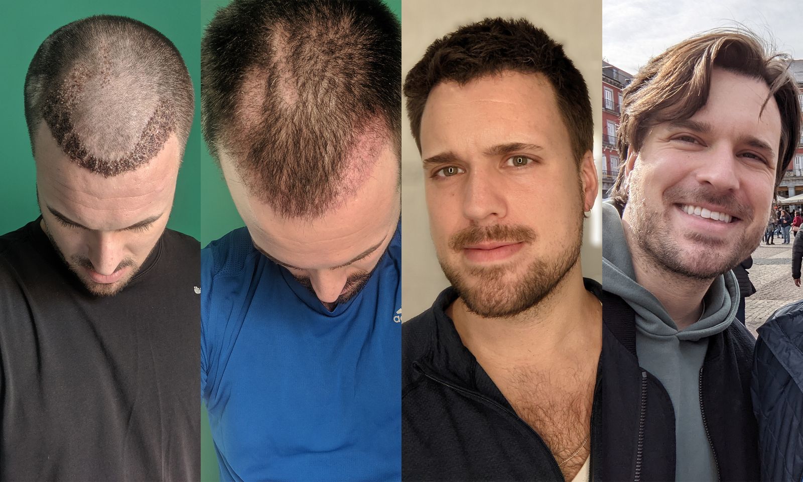 Taux de réussite d’une greffe de cheveux : ce qu’il faut vraiment savoir