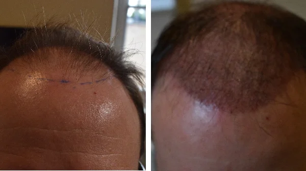 Greffe-capillaire-1-mois