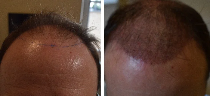 Greffe-capillaire-1-mois