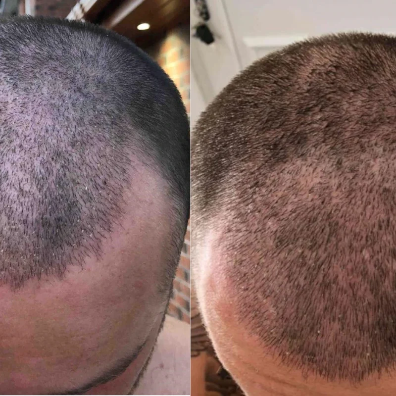 Greffe-capillaire-15-jours-apres