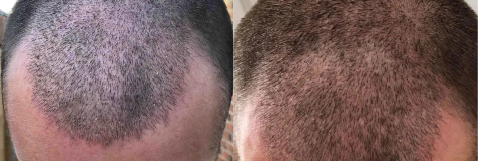 Greffe-capillaire-15-jours-apres