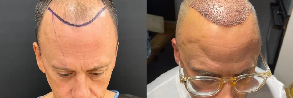 Greffe-capillaire-40-ans