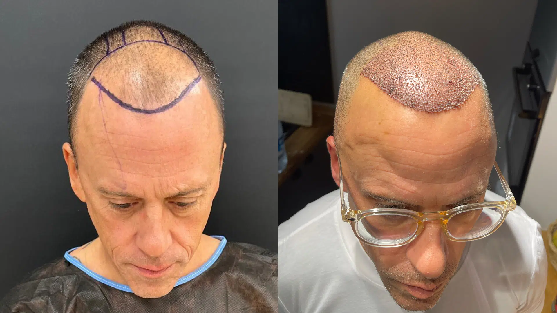 Greffe de cheveux à 40 ans : une solution sûre et efficace pour redensifier sa chevelure