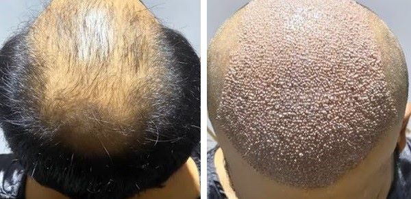 Greffe-capillaire-6000-greffons