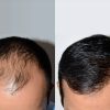 Greffe-capillaire-homme-prix