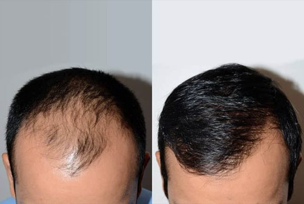 Greffe-capillaire-homme-prix