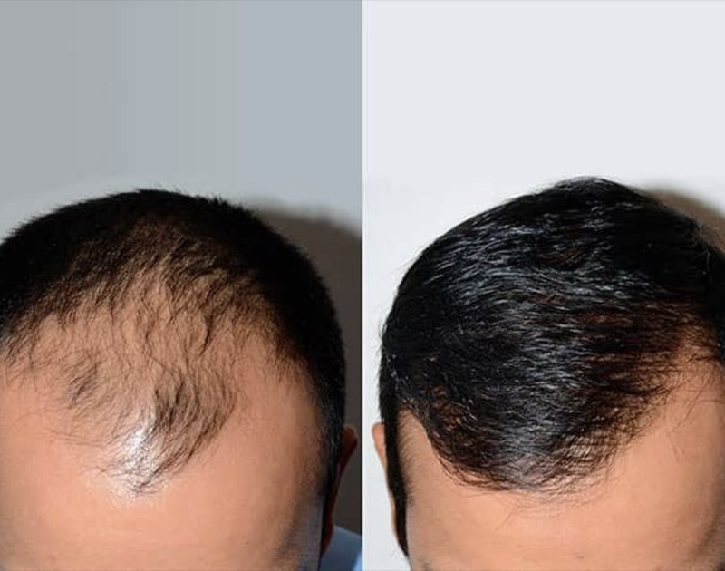 Greffe-capillaire-homme-prix