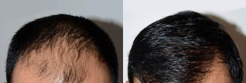 Greffe-capillaire-homme-prix