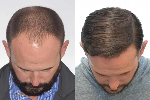 Greffe-capillaire-invisible