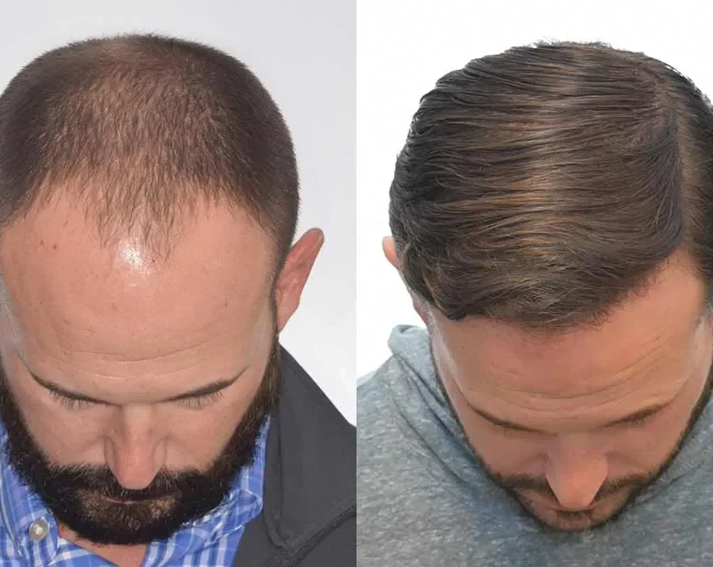 Greffe-capillaire-invisible