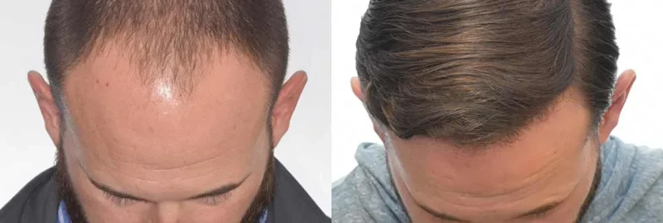 Greffe-capillaire-invisible