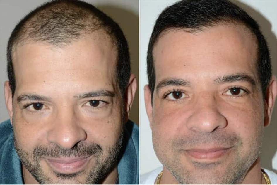 Technique-greffe-capillaire-homme