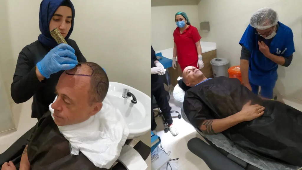 Techniques-de-greffe-de-cheveux-a-40-ans