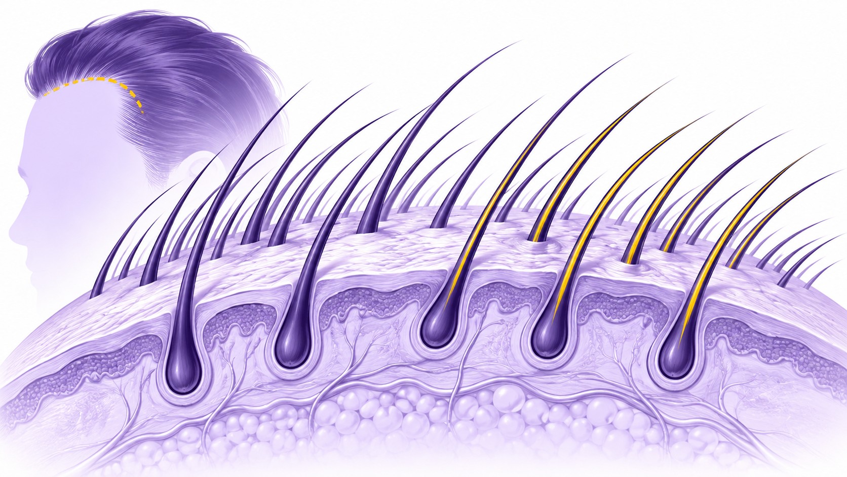 Maison Marignan / illustration éditoriale technique CHOI / coupe stylisée du cuir chevelu avec follicules pileux inclinés dans le même axe que les cheveux naturels, émergence oblique des tiges capillaires, alignement cohérent de l’angle et de la direction, mèches repérées en jaune parmi des cheveux violet foncé / 10 septembre 2026