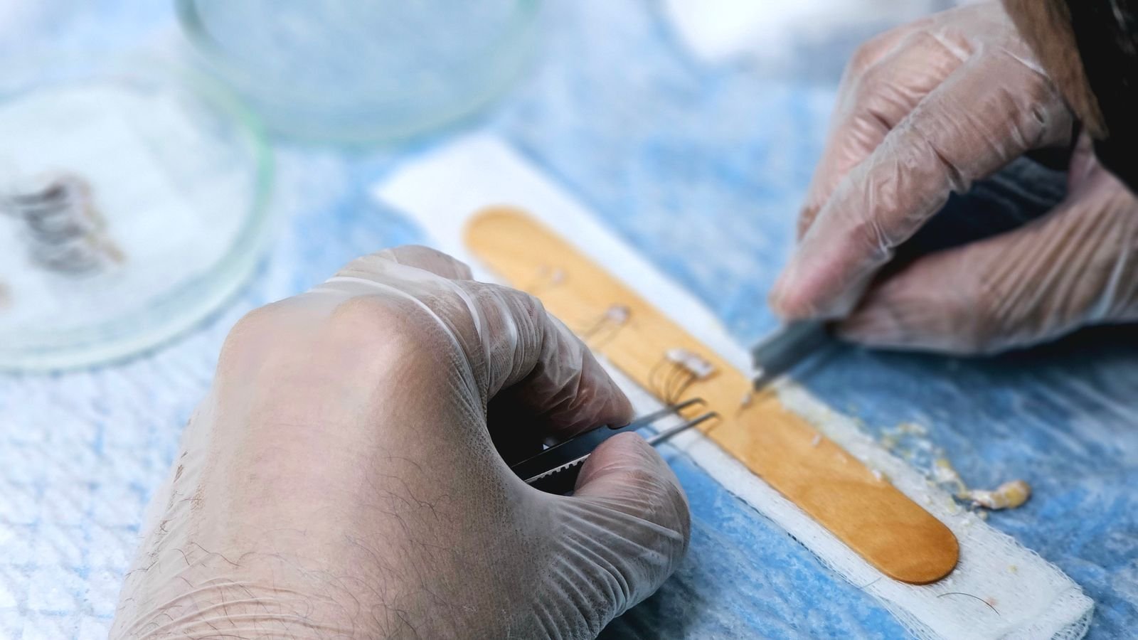 Préparation des greffons lors d'une greffe de cheveux Mains gantées préparant des greffons capillaires sur une table d'intervention